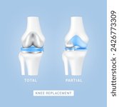 Knee replacement surgery total or partial implant for treatment relieve arthritis, after joint damaged. Leg bone and cartilage. Innovation medical technology treatment. Vector EPS10.