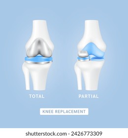 Knee replacement surgery total or partial implant for treatment relieve arthritis, after joint damaged. Leg bone and cartilage. Innovation medical technology treatment. Vector EPS10.