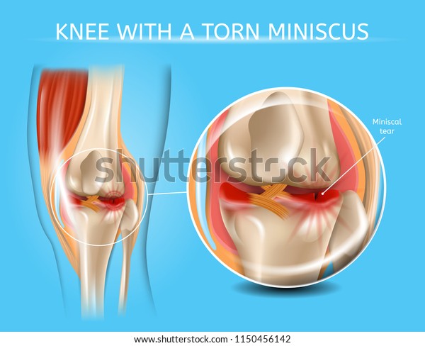 Ilustrasi Stok Knee Torn Meniscus Realistic Medical Scheme 1499601308 |  Shutterstock