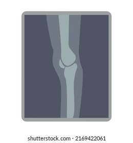 Knee x ray image semi flat color vector object. Patella dislocation. Avulsion fracture. Full sized item on white. Ligament injury simple cartoon style illustration for web graphic design and animation