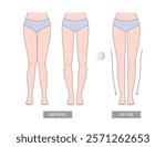 Knock knees, bow legs and normal legs. Knee valgus deformities. Healthy joint, knock-knee and Bow-leggedness. Corrective surgery