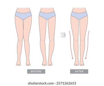 Knock knees, bow legs and normal legs. Knee valgus deformities. Healthy joint, knock-knee and Bow-leggedness. Corrective surgery