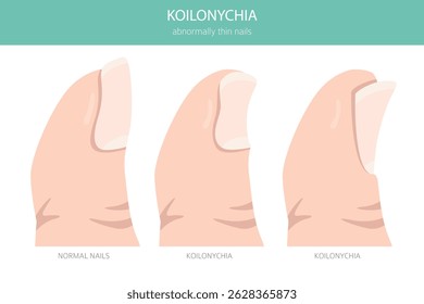 Koilonychia, or spoon nails, is a nail condition where nails become thin and concave. Medical infographic. Vector illustration