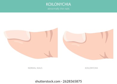 Koilonychia, or spoon nails, is a nail condition where nails become thin and concave. Medical infographic. Vector illustration
