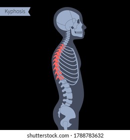 Kyphosis in child body. XRay flat vector illustration. Spine, backbone, joint and skeleton anatomy in boy silhouette. Orthopedic poster. Medical banner. Exam in spinal pain center or clinic.