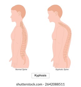 Kyphosis is an excessive forward curve of spine.This condition can cause to lean forward like hunching over. It might cause back pain.Medical health care, Vector illustration.