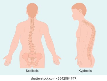 Kyphosis and scoliosis are both spinal conditions, but they differ in the direction of the spinal curvature. Medical health care, Vector illustration.