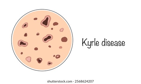 Kyrle disease. A dermatological disease manifested by the formation of small papules in the area of hair follicles. Color medical illustration.