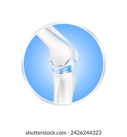 label aluminum. Knee replacement surgery total implant for treatment relieve arthritis, after joint damaged. Leg bone and ligament side. Isolated on white background for product design. 3d vector.