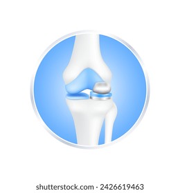 etiquetar aluminio. Cirugía de reemplazo de rodilla implante parcial para el tratamiento de aliviar la artritis, después de la articulación dañada. Cartílago del hueso de la pierna. Aislado sobre fondo blanco para el diseño del producto. Vector 3D realista.