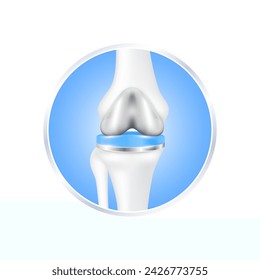 etiquetar aluminio. Cirugía de reemplazo de rodilla implante total para el tratamiento de aliviar la artritis, después de la articulación dañada. Cartílago del hueso de la pierna. Aislado sobre fondo blanco para el diseño del producto. Vector 3D realista.