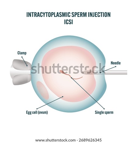 Labeled intracytoplasmic sperm injection ICSI diagram — educational medical illustration showing sperm injection into egg cell, IVF fertilization process, assisted reproductive technology infographic