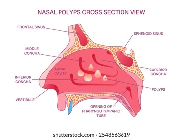 Diagrama de Seção Transversal de Pólipos Nasais Rotulados: Cavidade Nasal, Seios, Concha e Anatomia de Pólipos para Fins Médicos e Educacionais