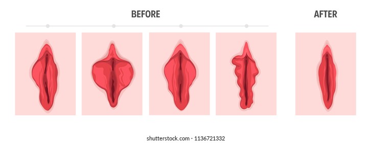 Labiaplasty ( vaginoplasty) . Types of female labia