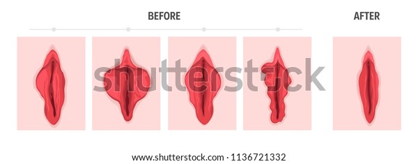 Labiaplasty Vaginoplasty Types Female Labia Stock Vector