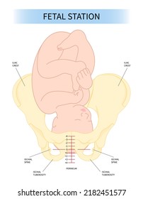 Labor C section praevia Mother twins cord hip lie bone fetal Baby born Head Down canal Left womb Right spine pelvis cervix score birth Breech defect vertex Exam uterus Frank Bishop weeks Infant