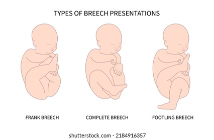 Labor C section praevia Mother twins cord hip lie bone fetal Baby born Head Down canal Left womb Right spine pelvis cervix score birth Breech defect vertex Exam uterus Frank Bishop weeks Infant