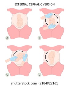 Labor C Section Praevia Mother Twins Cord Hip Lie Bone Fetal Baby Born Head Down Canal Left Womb Right Spine Pelvis Cervix Score Birth Breech Defect Vertex Exam Uterus Frank Bishop Weeks Infant