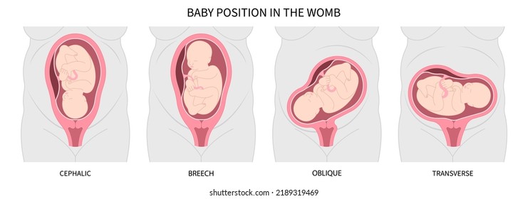 maniobra del bebé breech en el útero la anatomía médica