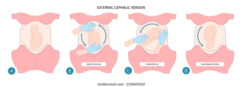 Labor C section praevia Mother twins cord hip lie bone fetal Baby born Head Down canal Left womb Right spine pelvis cervix score birth Breech defect vertex Exam uterus Frank Bishop weeks Infant