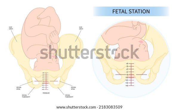 Labor C section praevia Mother twins cord hip lie\
bone fetal Baby born Head Down canal Left womb Right spine pelvis\
cervix score birth Breech defect vertex Exam uterus Frank Bishop\
weeks Infant