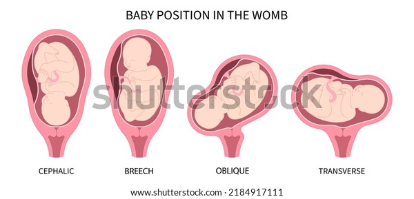 Labor C section praevia Mother twins cord hip lie
bone fetal Baby born Head Down canal Left womb Right spine pelvis
cervix score birth Breech defect vertex Exam uterus Frank Bishop
weeks Infant