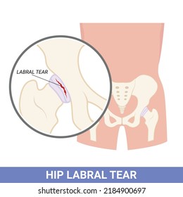 El labro de la cadera que desgarra y lesiona el trastorno en la medicina