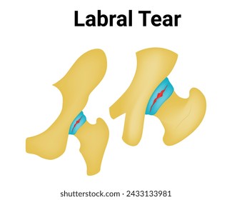 Labral Tear Science Design Vector Illustration Diagram