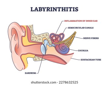 Laberinitis como infección interna del oído y esquema de inflamación médica. Plan educativo etiquetado con dolorosa condición y causa médica para la ilustración del vector de pérdida de audición y balance.