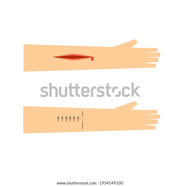 Laceration Wound Sutures Procedure Stock Vector (Royalty Free) 1934549330