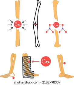 Lack of calcium leads to thinning of bone tissue and fragility of the limbs and neck of the thigh. Vector illustration. Leg day