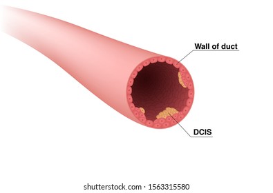 Lactiferous Duct And Ductal Carcinoma. DCIS. Vector Illustration Showing Cross Section Of Milk Duct With Cancer Cells.