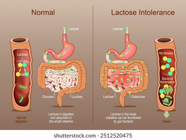 Lactose Intolerance. Cross section of a human intestine with Lactase, Glucose, Galactose. Сomparison of the normal digestion when lactose is digested and absorbed in the small intestine