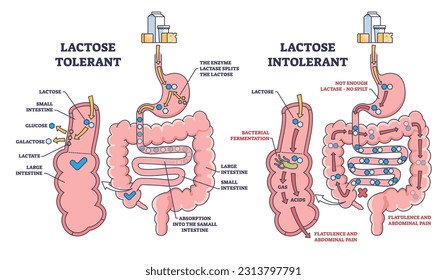 Lactose intolerance and tolerance medical process differences outline diagram. Labeled educational anatomical digestive tract splitting explanation with dairy milk allergy problem vector illustration