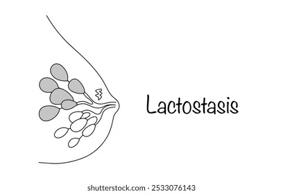 Lactostase. Dysfunktionaler Zustand der laktierenden Brustdrüse, Stagnation der Milch in den Kanälen der Brustdrüsen. Milchdrüse mit Stagnation der Milch im oberen Teil. Medizinischer Vektor.
