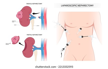 Laparoscope minimally invasive surgery for swelling kidney organ donation with Nephrectomy artery tract stenosis