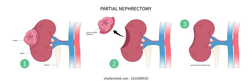 Laparoscope Nephrectomy surgery for kidney donation with minimally invasive swelling organ artery tract stenosis