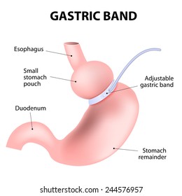 laparoscopic adjustable gastric band. lap-band, a band, or LAGB. Vector illustration