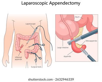 Laparoscopic appendectomy, instruments used and the removal of an inflamed appendix from the large intestine diagram hand drawn schematic vector illustration. Medical science educational illustration