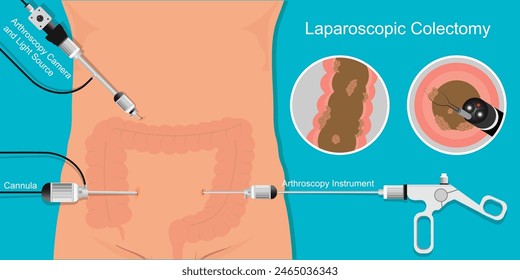 Laparoscopic colectomy surgery is inserted into the abdomen to remove the cancerous parts of the colon.The advantages of laparoscopic colectomy include small incision, less pain, faster recovery,vecto