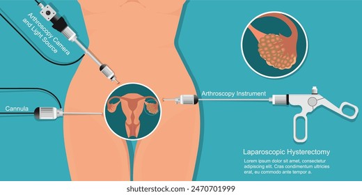 Laparoscopic fibroid removal is a minimally invasive procedure to remove uterine fibroids, growths in a woman's uterus, ovarian cancer, endoscope for surgical treatment.vector illustration.