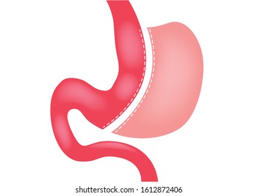 Laparoscopic Gastrectomy Gastric Sleeve / Weight Loss Surgery Vector

