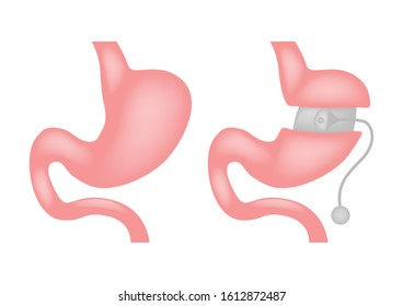 Laparoscopic Gastrectomy Gastric Sleeve / Weight Loss Banding Surgery Vector

