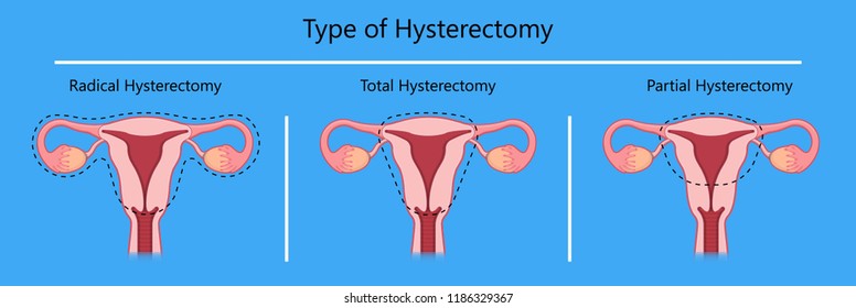 924 Hysterectomy Images, Stock Photos & Vectors | Shutterstock