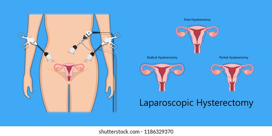 laparoscopic hysterectomy medical surgical treat cervix ovary subtotal minimally invasive procedure MIP Open UFE tumor agents diagnosis UAE guided Focused Ultrasound pcos syndrome cysts pmdd type