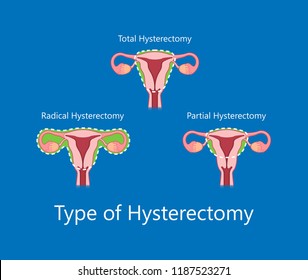 laparoscopic hysterectomy medical surgical treat cervix ovary subtotal minimally invasive procedure MIP Open UFE tumor agents diagnosis UAE guided Focused Ultrasound pcos syndrome cysts pmdd type