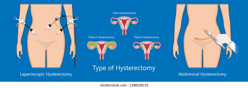 Laparoscopic Hysterectomy Medical Surgical Treat Cervix Stock Vector Royalty Free 1188528133 6293