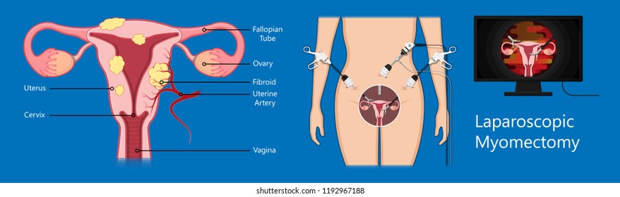 laparoscopic hysterectomy medical surgical treat cervix ovary subtotal minimally invasive procedure MIP Open UFE tumor agents diagnosis UAE guided Focused Ultrasound pcos syndrome cysts pmdd type