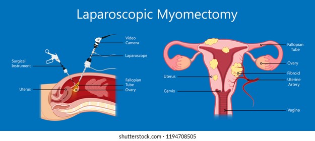 laparoscopic hysterectomy medical surgical treat cervix ovary subtotal minimally invasive procedure MIP Open UFE tumor agents diagnosis UAE guided Focused Ultrasound pcos syndrome cysts pmdd type