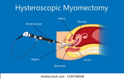 laparoscopic hysterectomy medical surgical treat cervix ovary subtotal minimally invasive procedure MIP Open UFE tumor agents diagnosis UAE guided Focused Ultrasound pcos syndrome cysts pmdd type